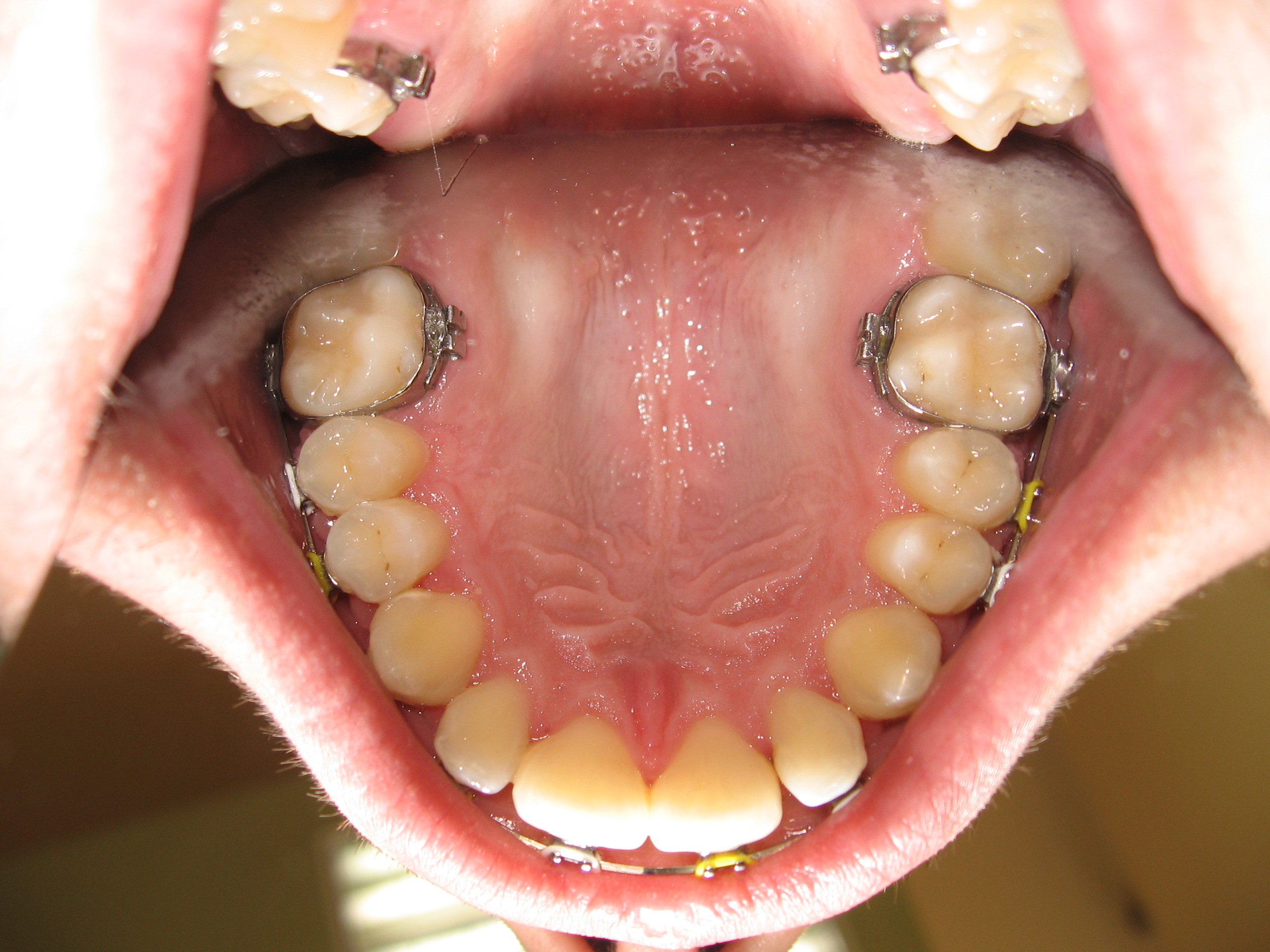 Pure Fertile gone crazy Ortodontie, estetica dentara, tratament ortodontic invizibil invisalign